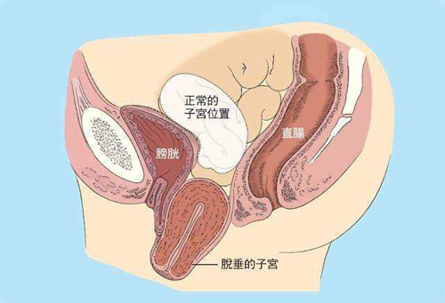 深圳千氧私密整形：阴道松弛久了会出现哪些问题？.png